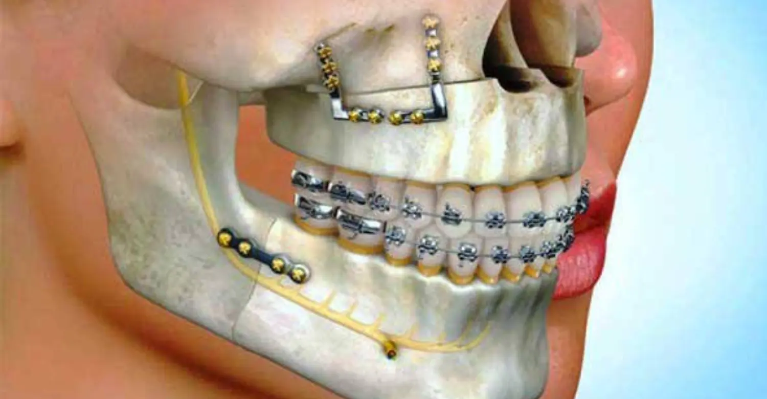 surgical orthodontics 2